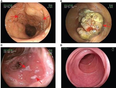 Successful treatment of a refractory intestinal Behcet’s disease with an oncology history by Vedolizumab: a case report and literature review